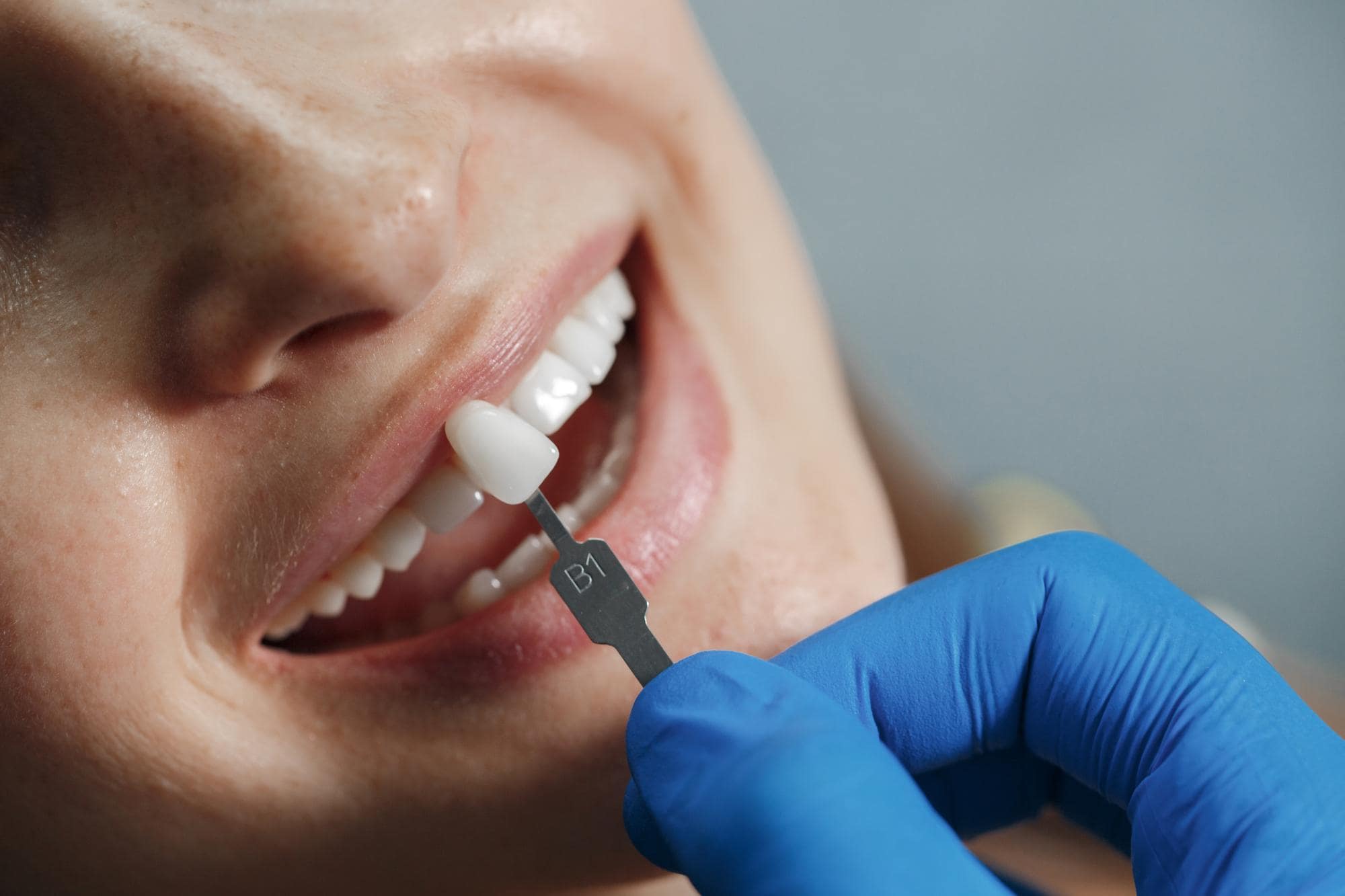 Dental implants